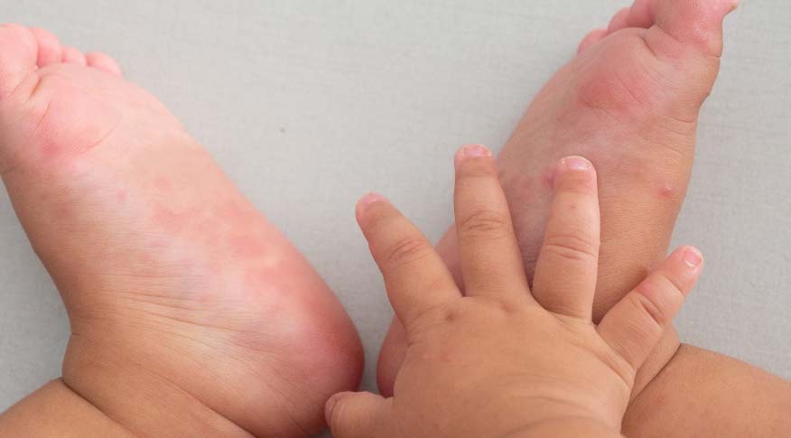 楊浩康(Yeung Ho Hong)醫生講解甚麼是手足口病