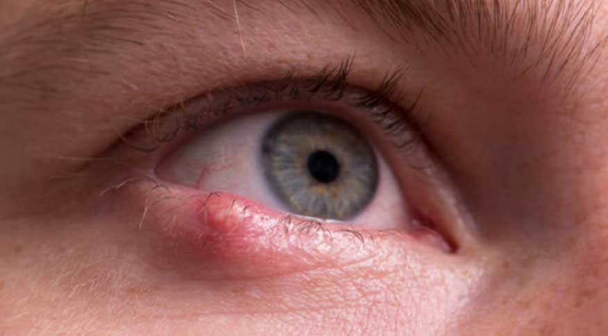 楊浩康(Yeung Ho Hong)醫生講解甚麼是麥粒腫(Hordeolum)