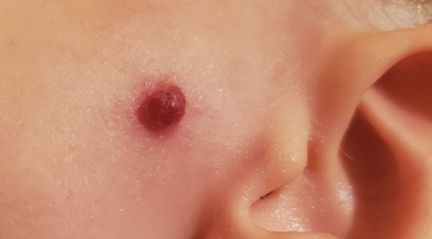 楊浩康(Yeung Ho Hong)醫生講解甚麼是化膿性肉芽腫(Pyogenic Granuloma)